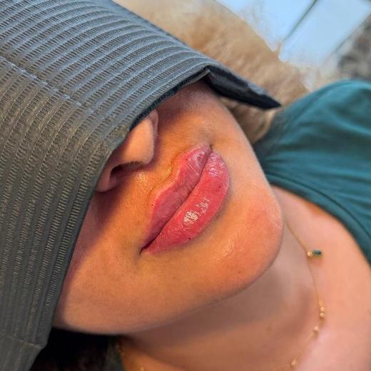 Ergebnis Lippenunterspritzung Mariposa Ästhetik