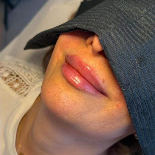 Ergebnis Lippenunterspritzung Mariposa Ästhetik