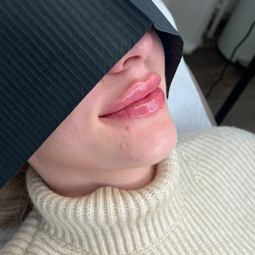 Ergebnis Lippenunterspritzung Mariposa Ästhetik
