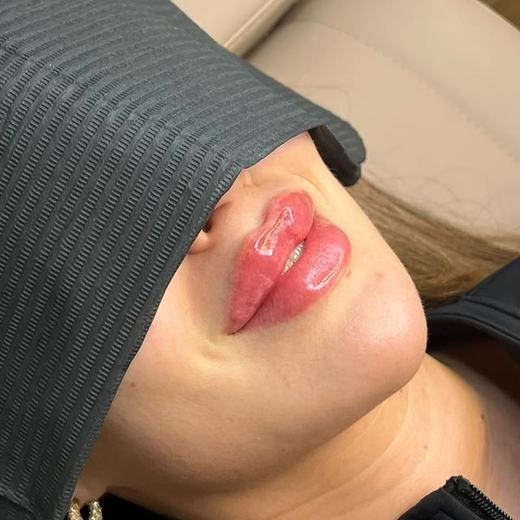 Ergebnis Lippenunterspritzung Mariposa Ästhetik